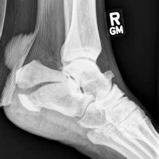 (PDF) Open tongue-type calcaneal fracture treated with the ...