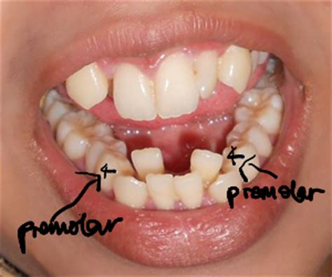 Untuk metal braces, pesakit boleh pilih warna elastic band/getah yang dipasang pada pendakap gigi. SEMANIS SENYUMAN DR.GIGI: ORTHODONTIK:SIAPA YANG PERLUKAN ...