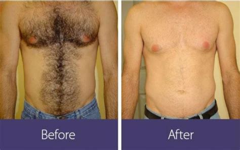 So, how does laser hair removal work? LASER HAIR REMOVAL - drkazemi
