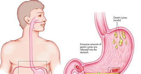 Cuka yang tinggi kalium dan membantu untuk menetralkan asam lambung. Obat Herbal Yang Sangat Ampuh: Obat Maag Tradisional Yang ...