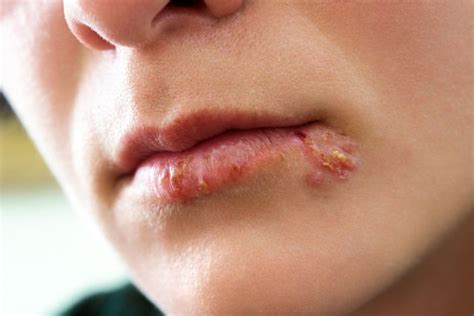 Am ansteckendsten sind herpesbläschen, kurz bevor sie auftreten und während sie sichtbar sind. Lippenherpes - Pflaster, Stift und Hausmittel - Was hilft ...