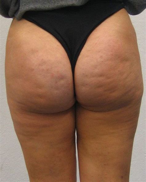 Ancient civilizations like rome, associated cleft or dimpled chins with virility. Pin on CELLULITE