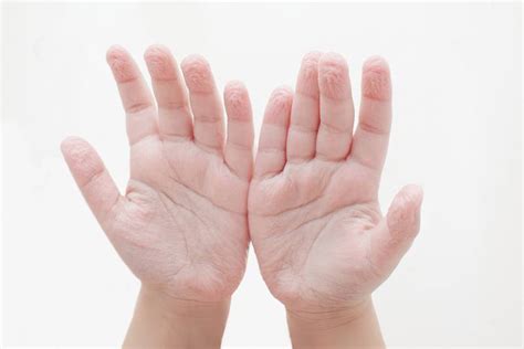 Pruned or Wrinkled Fingers Causes and Treatments | Skincarederm