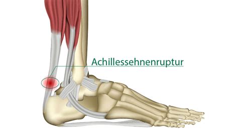 Bei einem achillessehnenriss (achillessehnenruptur) ist die sehne, die die muskeln an der hinterseite des unterschenkels (wade) mit dem fersenknochen verbindet, vollständig oder teilweise durchtrennt. Achillessehnenruptur - Wuppertaler Fuß - Initiative