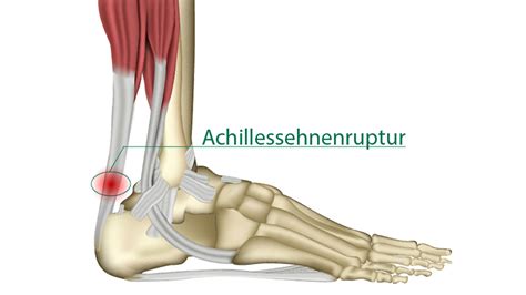 Es passiert aber immer wieder, dass teile der achillessehne oder sogar die ganze sehne reißen. Achillessehnenruptur - Wuppertaler Fuß - Initiative