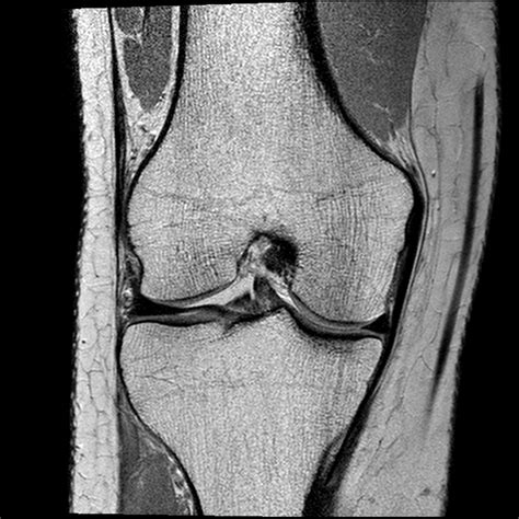 .on magnetic resonance imaging (mri) is most consistent with an anterior cruciate ligament (acl) tear? Normal ACL bundles on MRI | Image | Radiopaedia.org