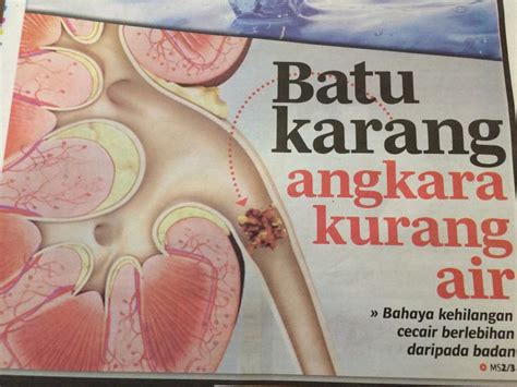 Batu ginjal atau (batu karang in english juga disebut kidney stone, nephrolithiasis atau urolithiasis) adalah mineral dan garam yang terbentuk di dalam ginjal anda. Selesaikan masalah sakit batu karang secara berkesan dan ...