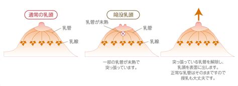 最高の画像: 最高 授乳 乳首 腫れ