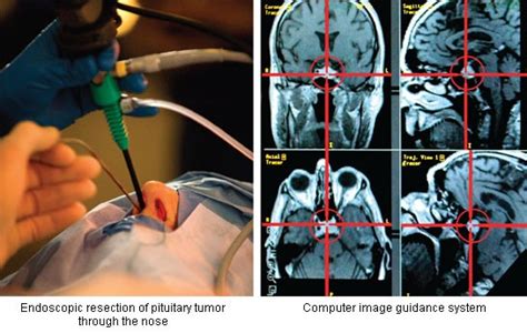 Intraoperative Endoscopy | Stanford Health Care