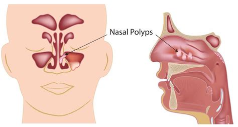 The nose has two holes called nostrils. Nasal Polyps - Otolaryngology Specialists of North Texas