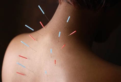 Acupuncture, chinese medicine and bodywork therapy can help you in some way. A Guide to Acupuncture - Medi Connect India