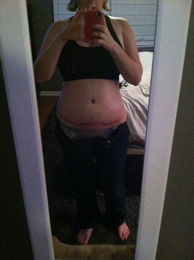 Stig is a 15 year old pupil on the verge of adulthood. Mommy Makeover! 11 Weeks PO - Mommy Makeover review - RealSelf