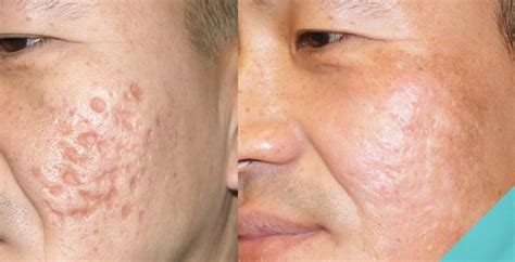 The laser emits a wavelength that penetrates the. Treatments for Getting Rid of Deep Acne Scars - Spa MD