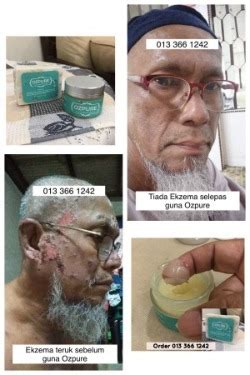 4=> scabies penyebab dari gatal pada selangkangan dan hitam ini. Pin on Krim Kulit Gatal Ozpure