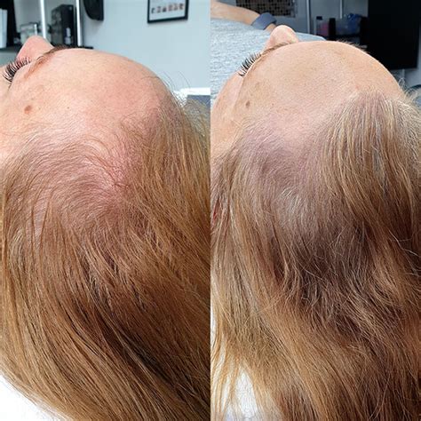 Smp can provide definition for full front, side and rear hairlines as well as restore a front hairline. Our clients ️ it | Before & After Scalp Micropigmentation ...