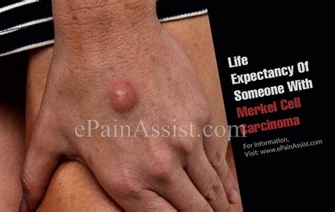Carcinoma is a type of cancer that develops in the skin or tissues covering or lining internal organs. Life Expectancy Of Someone With Merkel Cell Carcinoma