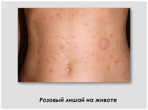 Лишай диета розовый жибера Розовый лишай Жибера - презентация онлайн Розовый лишай Жибера - презентация онлайн Лишай диета розовый жибера