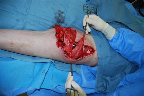 Flap Surgery: Autologous Tissue, Wounds, Microvascular Free Flaps ...