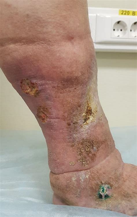 Ulcera trofica: cause, sintomi, diagnosi, trattamento e ...