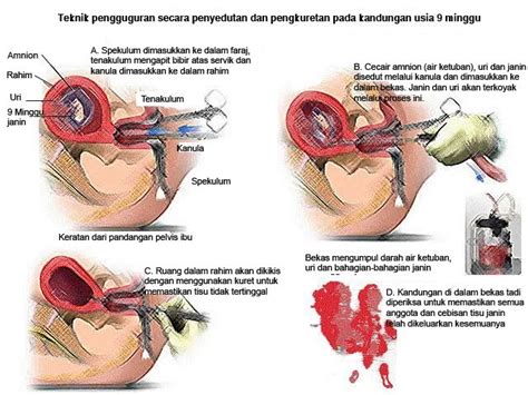 Ragi tape adalah zat yang dapat memicu fermentasi dan ragi juga dikenal sebagai bahan umum yang bisa memproduksi etanol di dalam minuman beralkohol seperti anggur dan bir. Amalina Yazid: pengguguran bayi