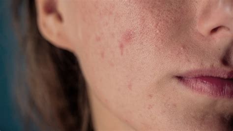 Bakterien der art staphylococcus aureus kommen auf der haut und den schleimhäuten von vielen gesunden menschen vor. Pickel und Rötungen -- wenn sich Stress auf deiner Haut ...