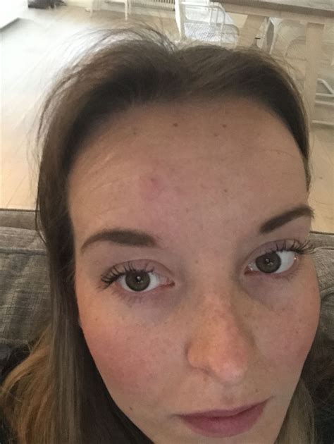 Det är oklart vad som utlöser sjukdomen. emeliesofieericsson.blogg.se