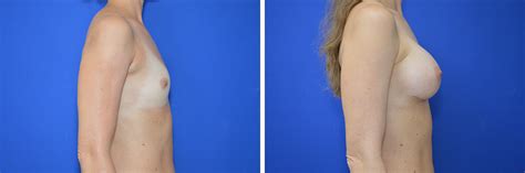 Eine operation, bei der die linke brust amputiert wurde, war. Brustvergrößerung mit sicheren Implantaten - Perfekte ...