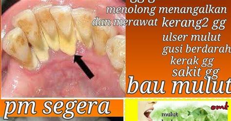 Ianya boleh berlaku pada bahagian bibir, gusi, pipi malah di bahagian tekak juga. Ubat Ulser Mulut Kanak - Harbolnas p