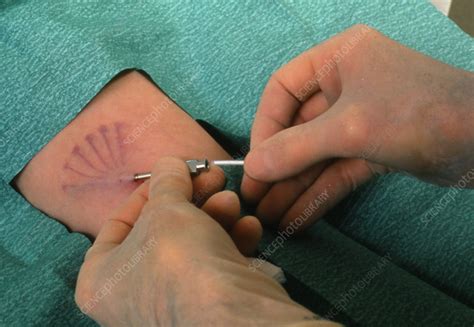 There are lots of different birth control options out there. Norplant contraceptive implant - Stock Image - M860/0122 ...