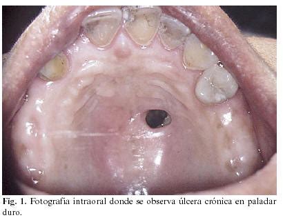 Mucormicosis rinocerebral, zigomicosis, necrosis de paladar. Perforación en bóveda palatina por consumo de cocaína