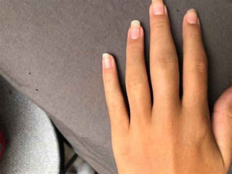 Einklemmen des fingers ist die häufigste ursache für eine fraktur. Gebrochen/Verstaucht? (Gesundheit, Heilung, Prellung)