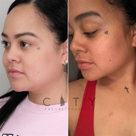 NYC Buccal Fat Removal Before and After Pictures | New York | UES