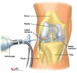 Detailed cortisone dosage information for adults. Migraine Shots Cortisone Pain Under Right Breast ...