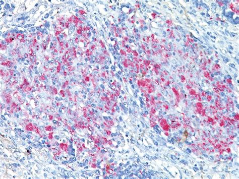 Nucleic acid amplification detection of dna or rna of live and dead cells with a sensitivity. Jurnalis Rifai Pamone Meninggal Karena TB Kelenjar Getah ...