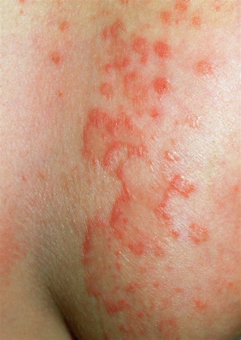 This rubbing can cause a breakdown in the top layers of the skin, causing inflammation. Intertrigo - Dermatitis On The Lower Breast Photograph by ...