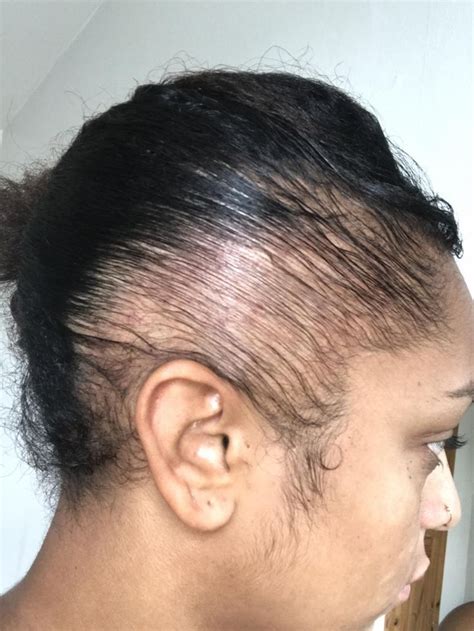 Hair loss is different than hair shedding. Traction Alopecia: Young Female Singer Warns of Self ...