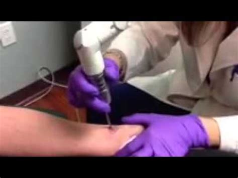 Compared to traditional methods of tattoo. Laser Tattoo Removal Fotona QX Max Cleveland, Ohio ...