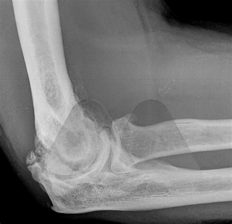 Stiff Elbow and osteoarthritis - Avanthi Mandaleson