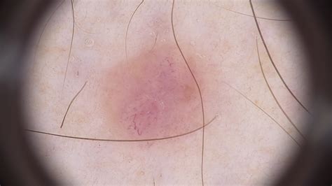 Schwarzer hautkrebs entwickelt oft dunkle wucherungen (melanome), denen er seinen namen verdankt und die aus den pigmentzellen entstehen, die den braunen hautfarbstoff produzieren. „roter" schwarzer Hautkrebs - Bosch & Bosch