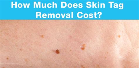 Meeting with a dermatologist can be pricey but how pricey? How Much Does Skin Tag Removal Cost? | Getting Rid of Skin ...