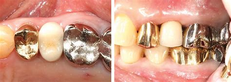 Position and conclusion are semantically related. Custom healing abutments as an option for successful ...