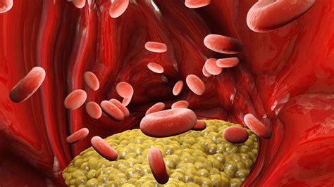 La trombosis cerebral es un tipo de acv que ocurre cuando un coágulo de sangre obstruye una de las arterias del cerebro, causando síntomas como parálisis de la mitad del cuerpo y la boca torcida. Trombosis: síntomas y prevención - Hogarmania