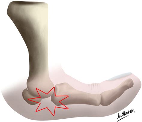 Turf toe is essentially a sprain or hyperextension of the toe. Turf toe and sesamoiditis: what the radiologist needs to ...