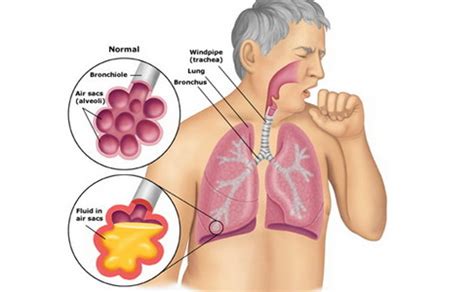 Tibi atau penyakit batuk kering adalah sejenis penyakit berjangkit yang boleh membawa maut jika tidak diubati. Penyakit Tibi Paru - Paru