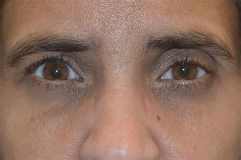 Exophthalmos, abnormal protrusion of one or both eyeballs. Case 7 - Graves Exophthalmos - Before and After Gallery