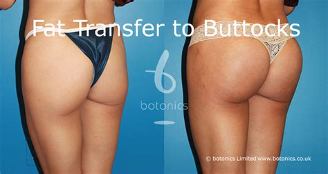 The initial stage of cellulite is characterized by the fact that the lost elasticity of the skin appears sagging buttocks and thighs. Fat Transfer Before & After Photos Comparison in London, UK