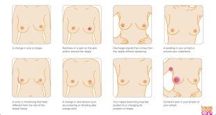 Symptoms of inflammatory breast cancer include swelling (edema) and redness (erythema) that affect a third or more of the breast. Breast Cancer Signs and Symptoms in Urdu. | All In One ...