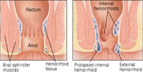 Hemorrhoids or piles are really common and many people have the condition or had it at some news update: Disorders & Treatment | Doctor Butler's Hemorrhoid ...