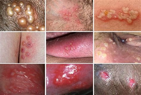 One of these reasons it that it is itchy and you scratch it. How Long Does a Genital Herpes Outbreak Last? - Public Health