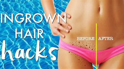 Black spots and scars are often the result of ingrown hair, when they occur in the pubic area or upper thigh. INGROWN HAIR HACKS | GET RID of INGROWN HAIRS | Paris ...